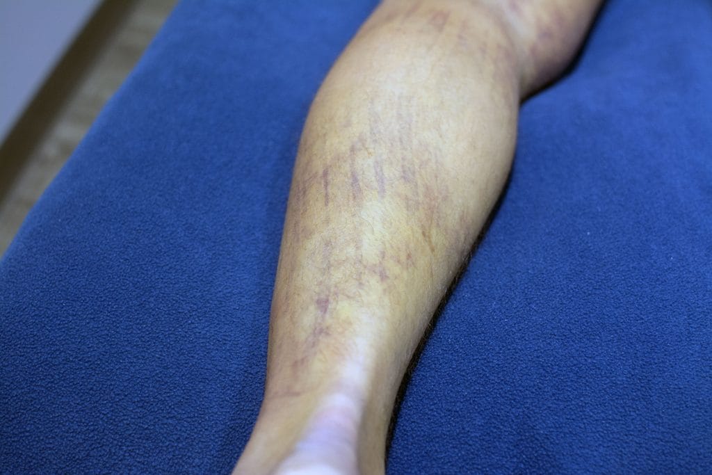 30 hours after applying Kinesiology Tape and 2 laser sessions.