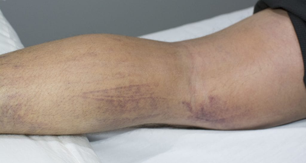 5 days after initial intake at clinic, 4 laser sessions.