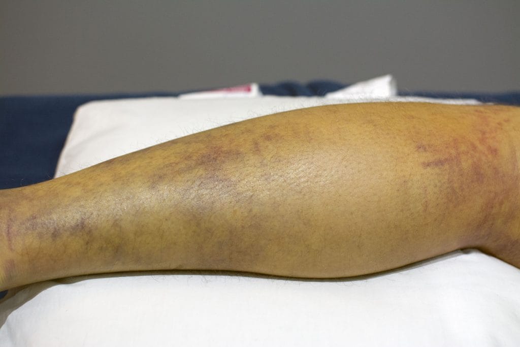 hamstring rupture bruising - 7 days post injury.