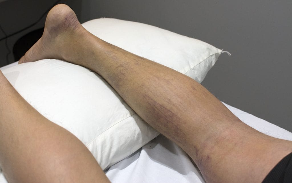 5 days after initial intake at the clinic. 4 laser therapy sessions.