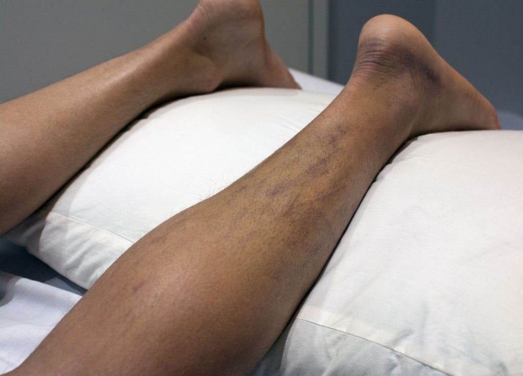 5 days after initial intake at clinic, 4 laser sessions.